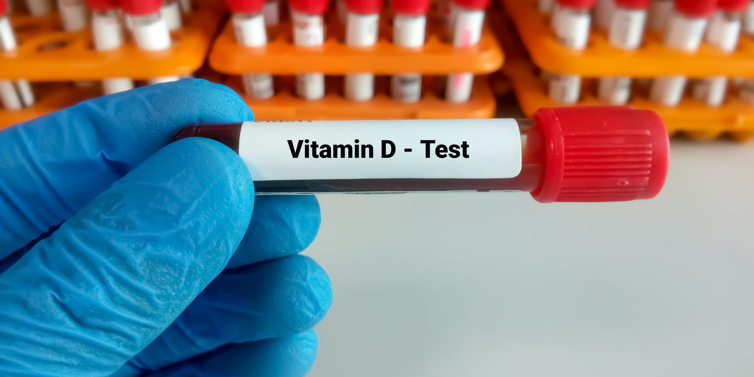 Blood,Sample,For,Vitamin,D,Test,With,Laboratory,Background.,Close